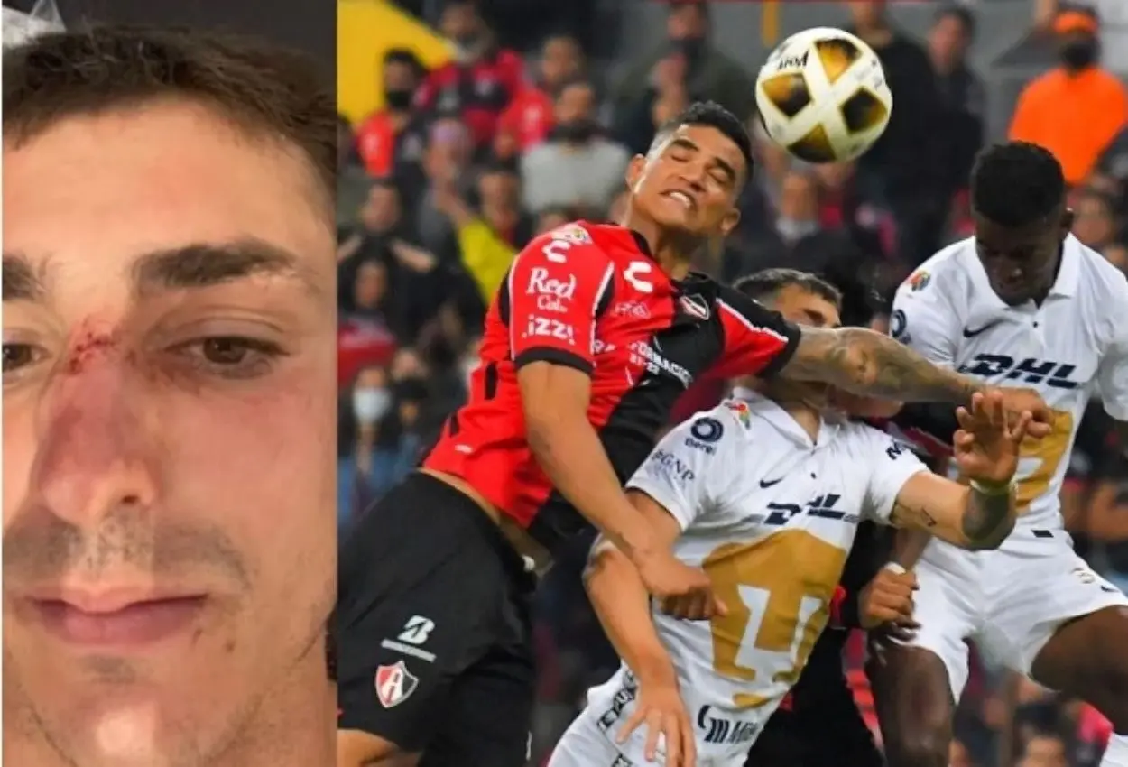 Juan Dinenno compartió en sus redes sociales el golpe que sufrió en el partido. Foto: Captura de pantalla-MarcaClaro.