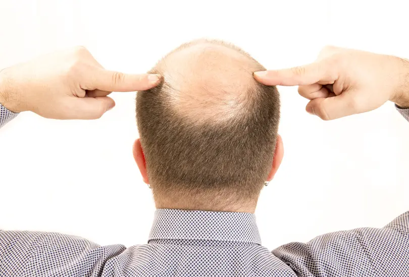 Futbolistas y entrenadores que cambiaron su look injert&aacute;ndose cabello