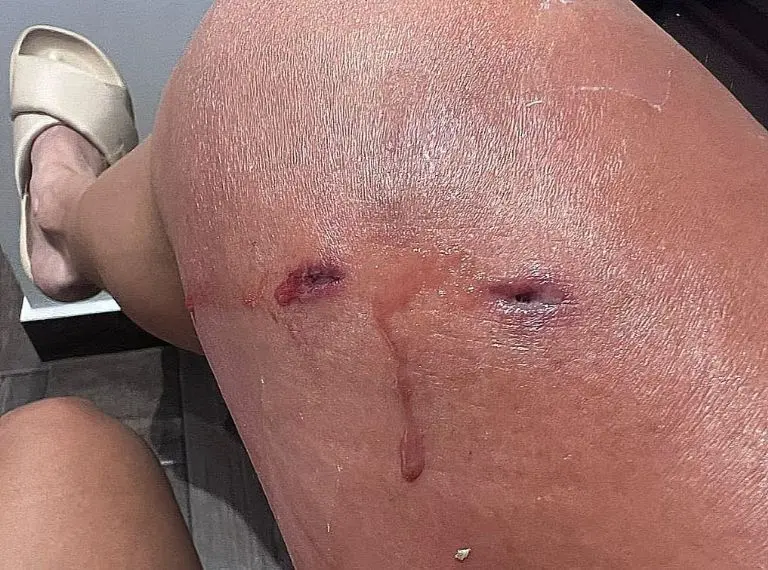 La Barby Juárez sufrió una mordedura por parte de un perro. Foto: Captura de pantalla.