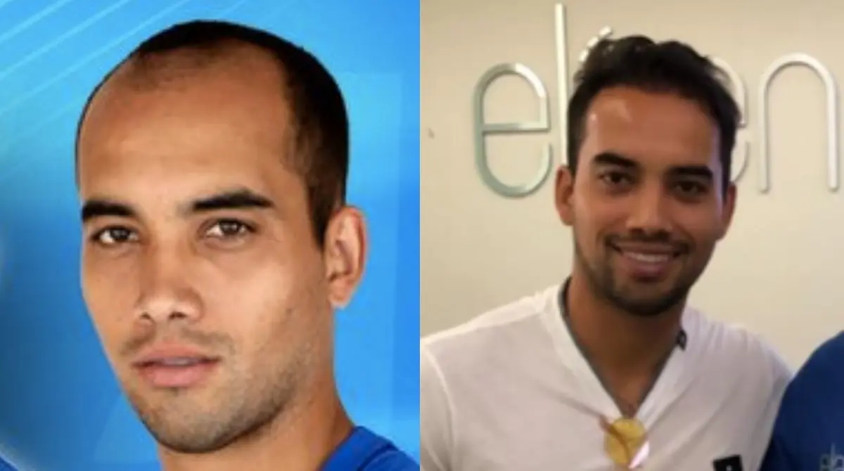 ADRI&Aacute;N ALDRETE. Durante su etapa como futbolista de Cruz Azul, el lateral mexicano fue perdiendo cabello de una manera evidente, siendo 2018 donde qued&oacute; completamente delatado. Para 2019 sorprendi&oacute; al estrenar una abundante cabellera, recomendando incluso cl&iacute;nicas para el tratamiento capilar.