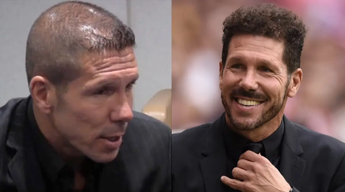 DIEGO SIMEONE. Entre 2013 y 2014, el &acute;Cholo&acute; "remont&oacute;" el problema de la calvicie recurriendo al m&eacute;todo FUE, donde se injertan los fol&iacute;culos de forma individual sobre el cuero cabelludo. El estratega argentino pas&oacute; de ser una v&iacute;ctima m&aacute;s de la alopecia a tener un cabello completamente frondoso.