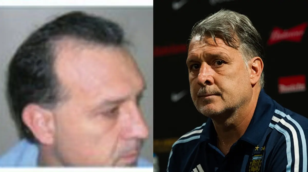 GERARDO MARTINO. El &acute;Tata&acute; Martino se someti&oacute; a un tratamiento en su cuero cabelludo durante su estancia con la Selecci&oacute;n de Paraguay en el lejano 2010. El exentrenador de la Selecci&oacute;n Mexicana arrastraba un problema capilar de grado cuatro, mismo que trat&oacute; exitosamente y le fue de ayuda para el futuro.