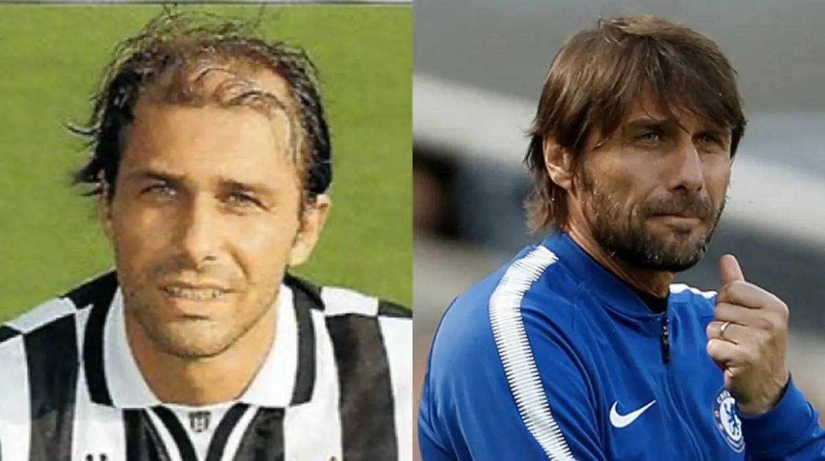 ANTONIO CONTE. El ahora entrenador italiano no solo destac&oacute; por su habilidad con la pelota durante su &eacute;poca profesional, sino que tambi&eacute;n por el aspecto de su cabellera. La parte superior de su cabeza resaltaba por el poco poblamiento de cabello, situaci&oacute;n que cambi&oacute; radicalmente para su etapa como entrenador, donde se convirti&oacute; completamente en otro.