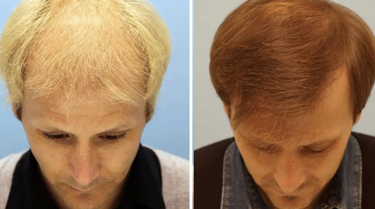 GAIZKA MENDIETA. Este exfutbolista y exestrella del Valencia decidi&oacute; cambiar radicalmente su estilo cuando estaba por dejar las canchas, aproximadamente por 2008. El rubio que lo caracteriz&oacute; durante gran parte de su carrera qued&oacute; atr&aacute;s al cambiar su color y reforzar su cuero cabelludo.