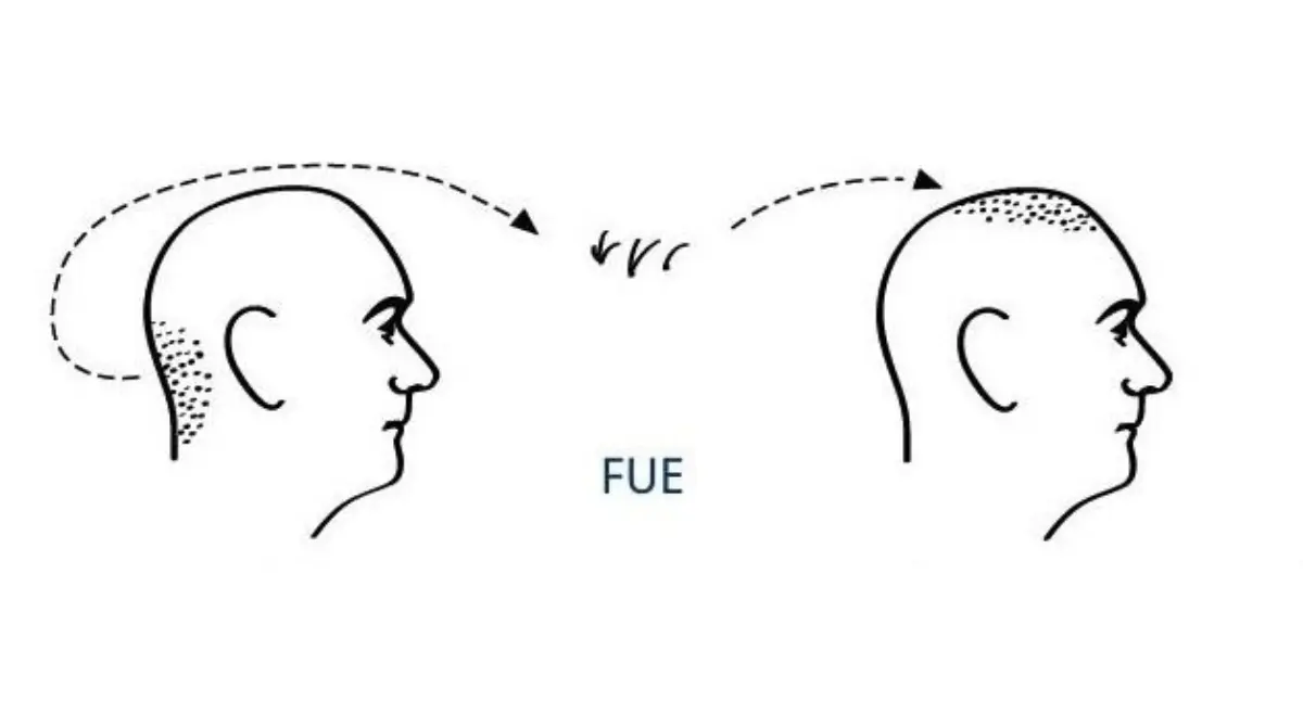 El injerto capilar es un procedimiento quir&uacute;rgico y est&eacute;tico que ha tomado relevancia durante los &uacute;ltimos a&ntilde;os, no solo en personas que hacen frente a la calvicie, tambi&eacute;n entre futbolistas y entrenadores.