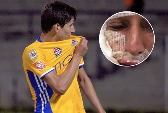 Jürgen Damm sufrió un accidente con pirotecnia que le afecto el rostro con quemaduras de primer grado, pero pudo haber sido el final de su carrera.