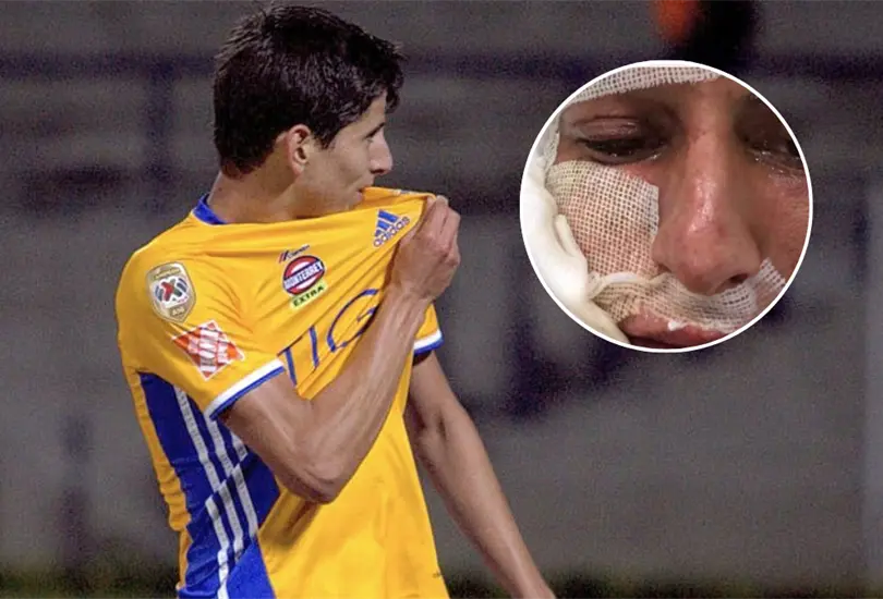 J&uuml;rgen Damm sufri&oacute; un accidente con pirotecnia que le afecto el rostro con quemaduras de primer grado, pero pudo haber sido el final de su carrera.