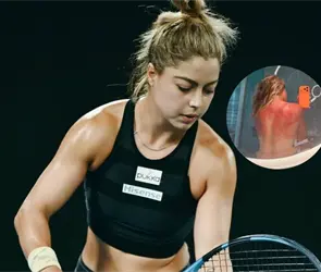 &iexcl;Brutal! Renata Zaraz&uacute;a muestra quemaduras por el sol en Australia